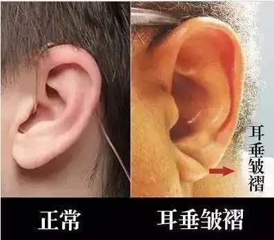 2,耳垂长皱纹(冠心沟)