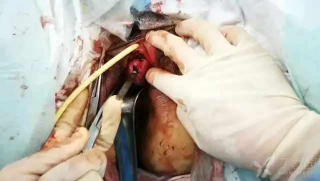 特殊病例阴道前壁尿道下方膀胱外窦道 - 妇产专业讨论版 -丁香园论坛