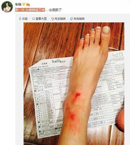 车晓晒腿部受伤照:第一次从楼梯滚下来