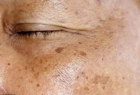 关于去斑,这几点你会想知道_皮肤