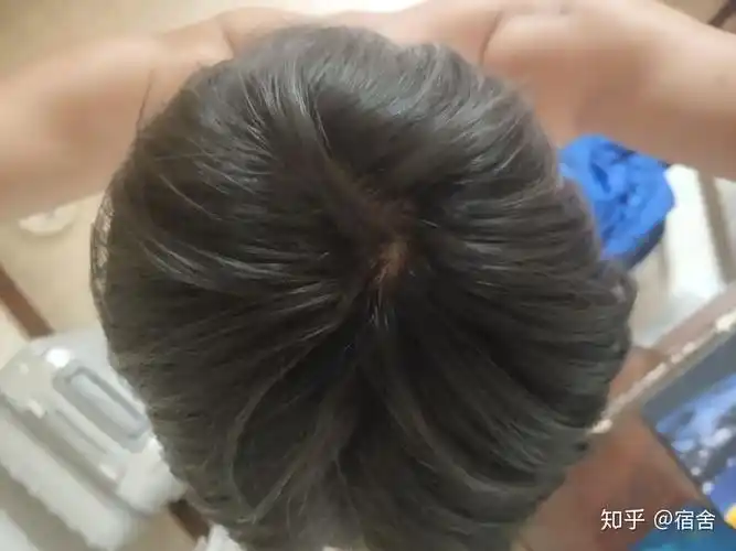 头上这样的发旋正常不
