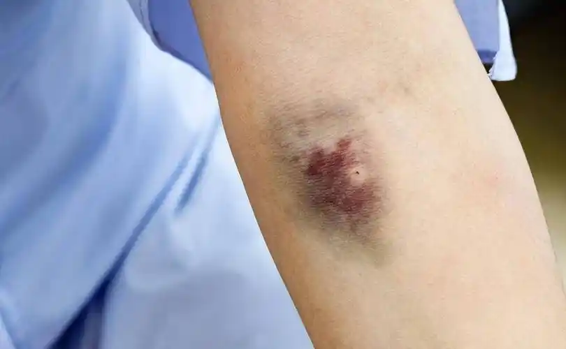 这种方法很简单!_胳膊_血管_来源