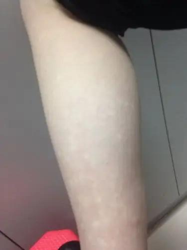 小腿上很多白斑,十来年了,现在越来越多,不动的时候会这样大片大片