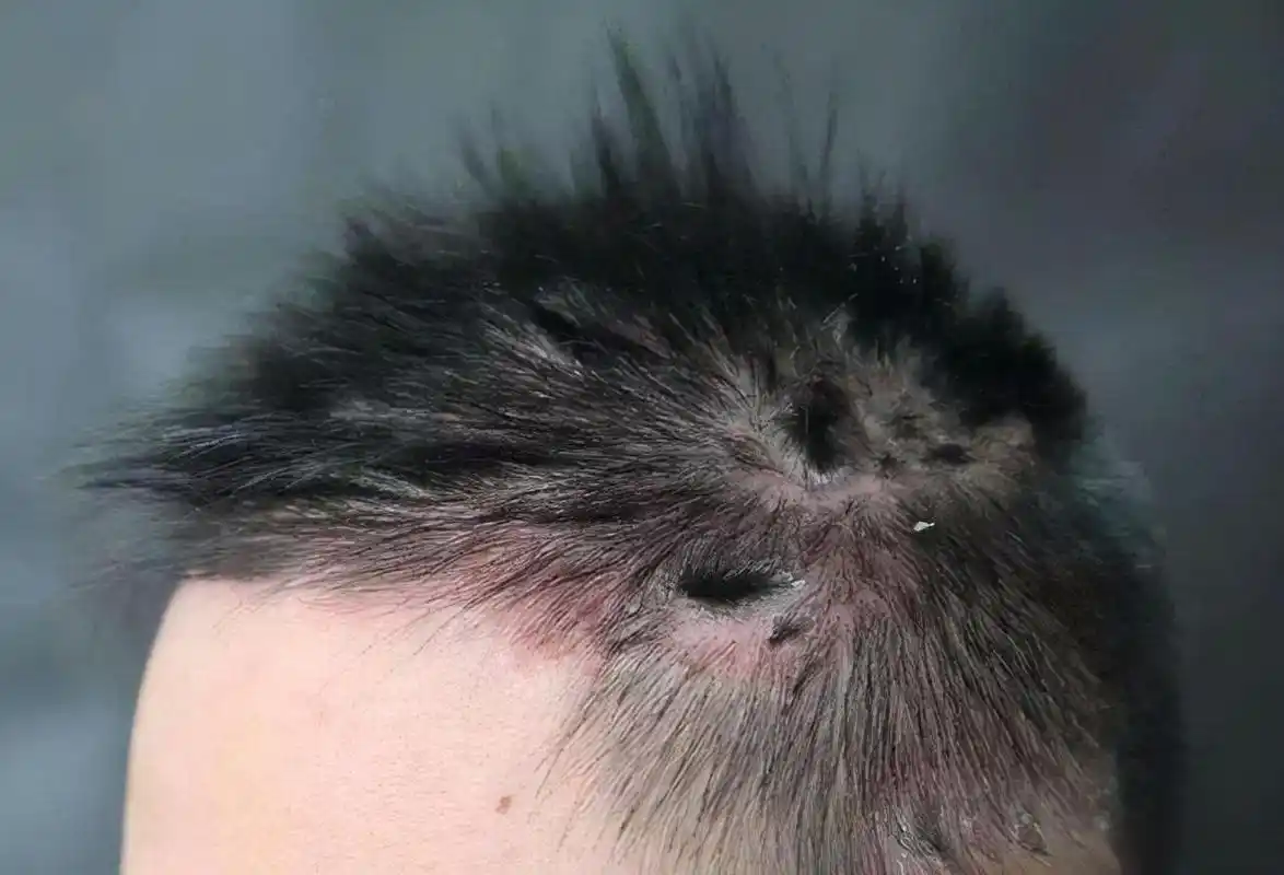 头皮上长出的脓包与疙瘩是什么物质?应该如何减轻这种症状?