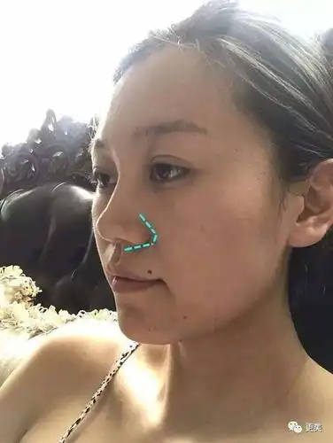 鼻翼基座切除,就是鼻子状态一般,只是很低,鼻头大,就可以在鼻翼基座