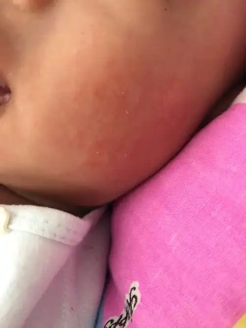 宝宝脸上起湿疹擦完汇通术泰以后就这样还有点蜕皮 正常嘛