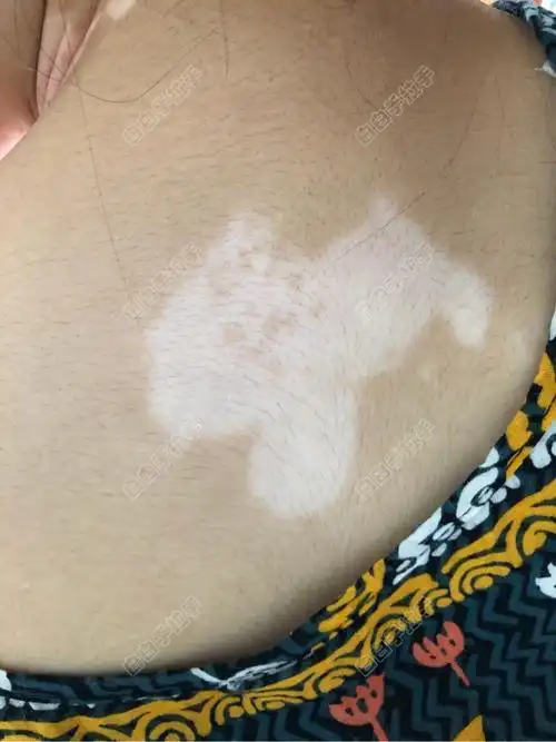 背部白白一角,白白治疗不知不觉五个月了!