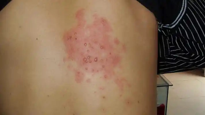 药疹图片 (30)_有来医生