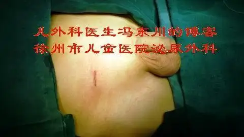 上图可见外院是在阴囊上开的手术切口,行睾丸鞘膜翻转术,术后鞘膜积液