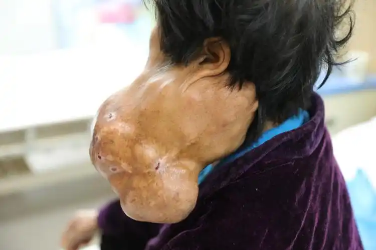 颈部巨大肿瘤切除,西安交大二附院mdt团队联手助患者重获新生