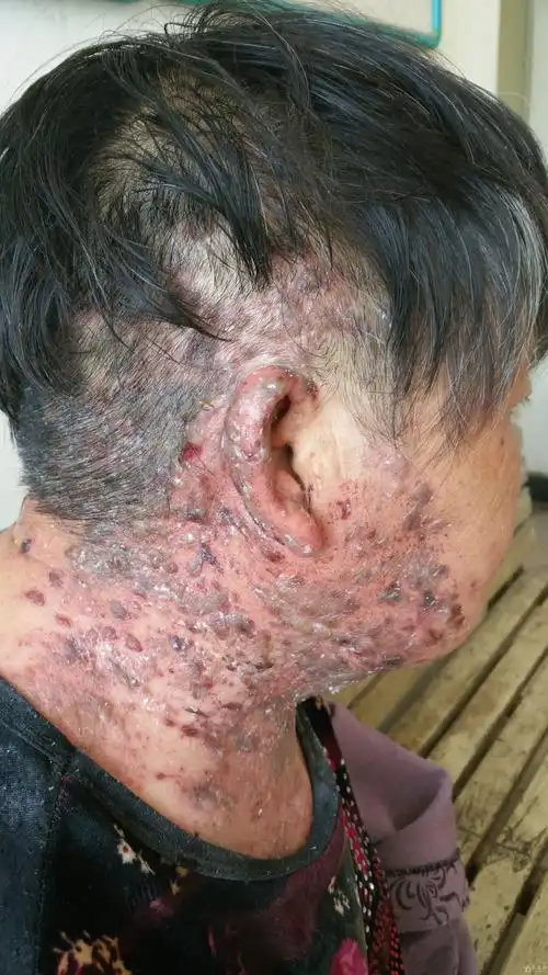 一例严重带状疱疹病例 合并躯体单纯疱疹病例 附图片 - 皮肤及性传播