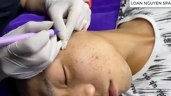 针挑手法 解压 助眠 看着黑头挑出来-vlog视频-搜狐视频