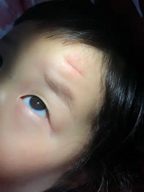 宝宝额头磕伤胶水粘合第23天