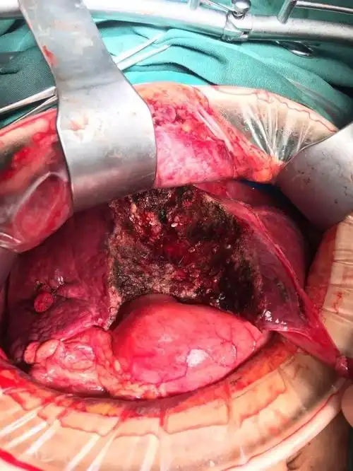 只争朝夕不负韶华巴中市中心医院普外二科2019年终总结