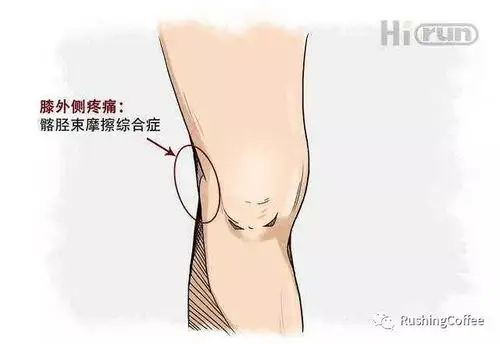 一组瑜伽动作有效缓解跑步大腿外侧疼痛风暴健身