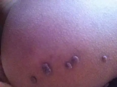 阴囊唇长了个小硬疙瘩是怎么回事(阴囊唇长了个小硬疙瘩是怎么回事