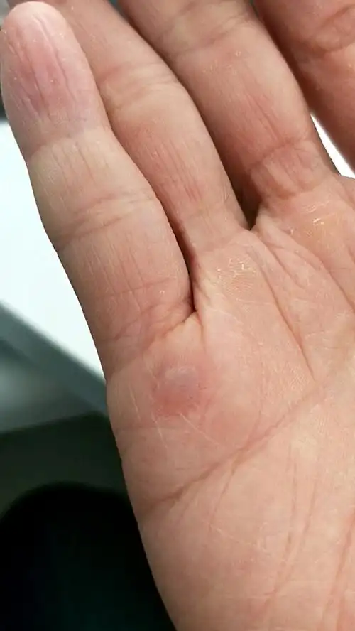 做了几组器械训练把手磨起泡了