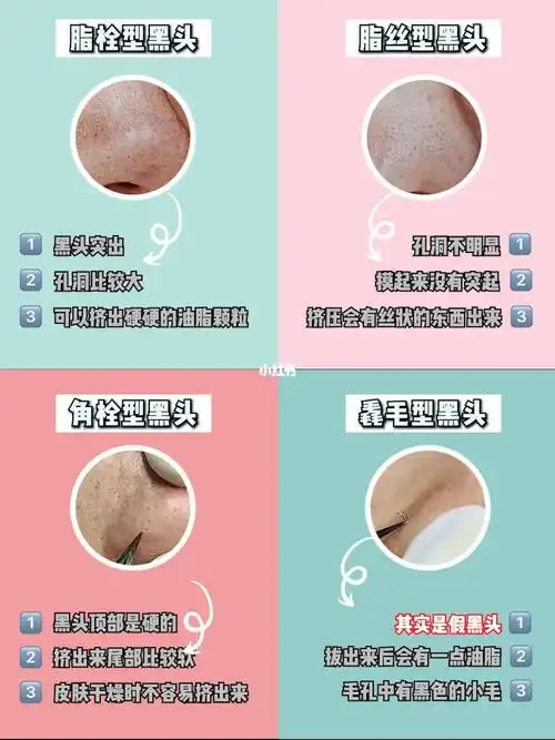 黑头:孔洞不明显,摸起来没有突起,挤压会有丝状的东西出来角栓型黑头