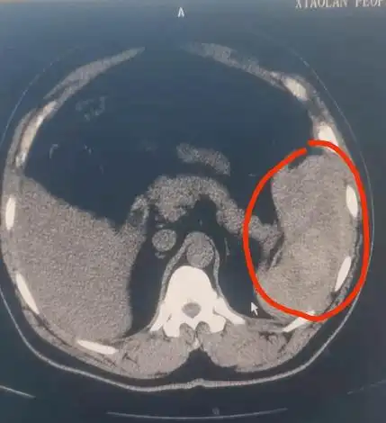 中山一男子脾破裂,起因竟是这种常见的亲子游戏.