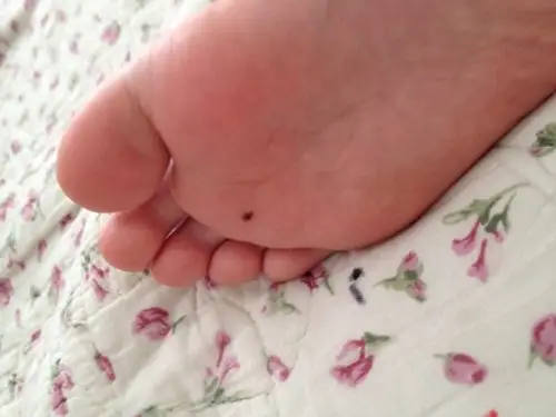 孩子前脚掌有颗痣,好还是不好