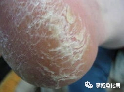 掌跖角化病通常表现为手掌,足跖部等部位皮肤粗糙增厚