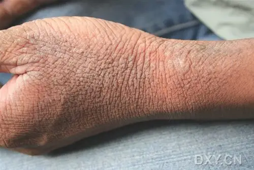 【病例讨论】水源性掌跖角化病(aquagenic palmoplantar keratoderma)