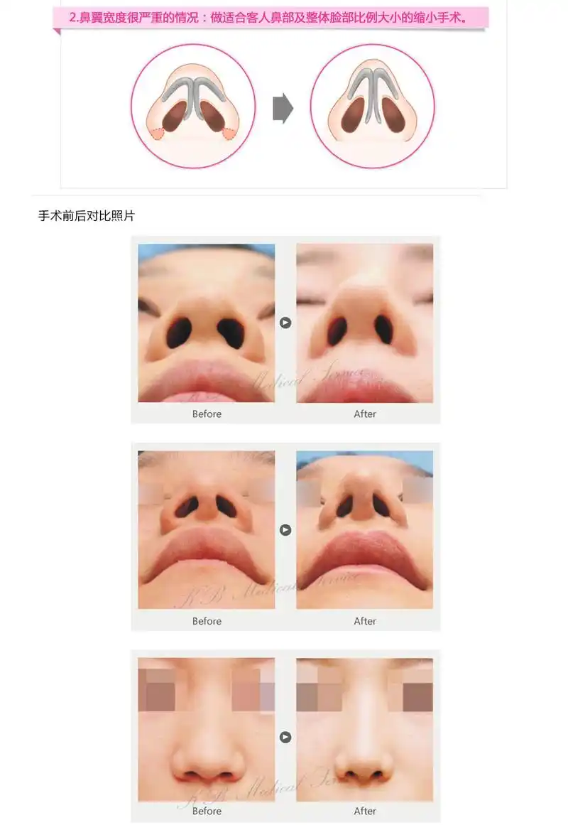 鼻翼缩小手术,韩国鼻部整形,韩国整形,韩国整容