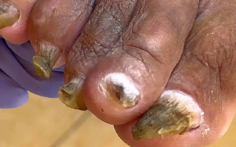 【灰指甲】严重甲真菌病,脚趾甲全是黑泥