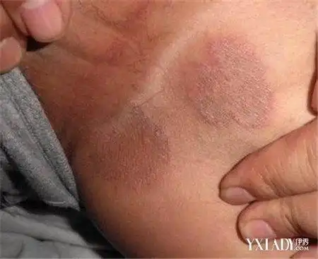 【图】美女大腿肚内侧黑了是怎么回事 一种股癣困扰着大家