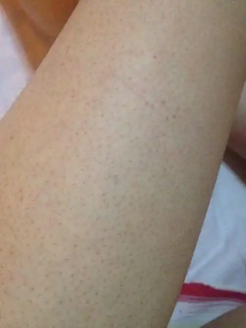 宝宝毛囊角化怎么办