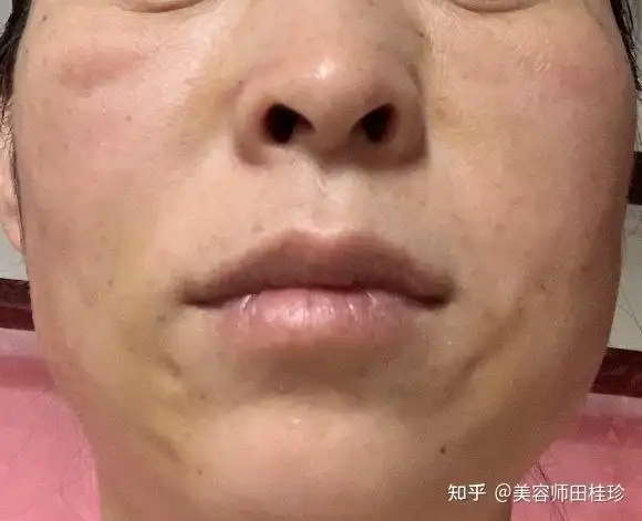 热玛吉过后脸颊凹陷