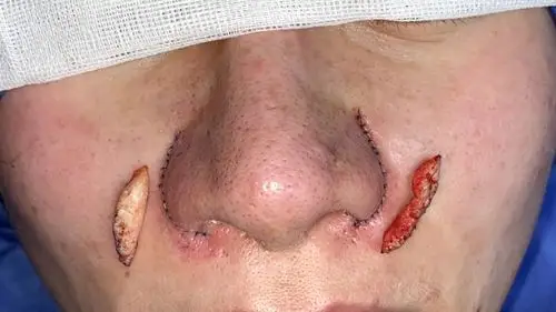 疤痕被完整切除:手术操作中既需要考虑鼻翼正面的左右的对称性,高低的