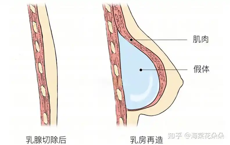 乳房切除后是选择乳房重建术好还是佩戴义乳好