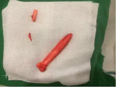 关于膨体隆鼻,你可能不知道的5个"隐秘的角落"_隆鼻_治疗介绍_风险