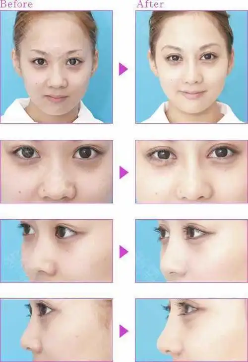 先来看一组鼻翼缩小的对比图吧!