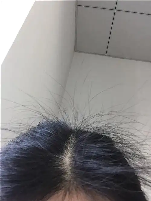 头发炸毛成这样怎么办啊