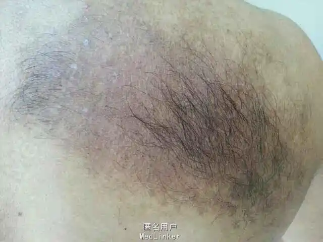 病史:患者出生后即发现右侧肩胛部咖啡色斑片,无痒痛,未进行治疗