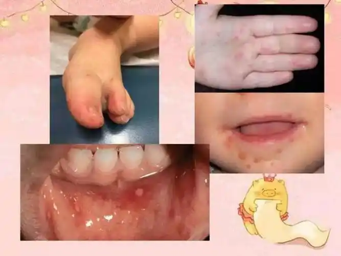 宝宝5个月大手足口病图片_有来医生