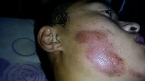 骑车摔了擦伤脸部请问是否会留下疤痕或者黑色印记