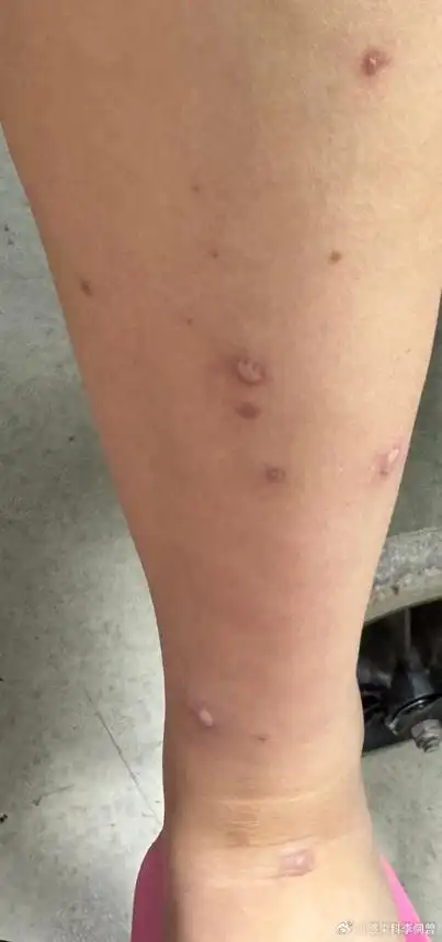 昨天有个三十多岁女性感染了水痘,还合并脑炎昏迷了一天,真是够惊险的