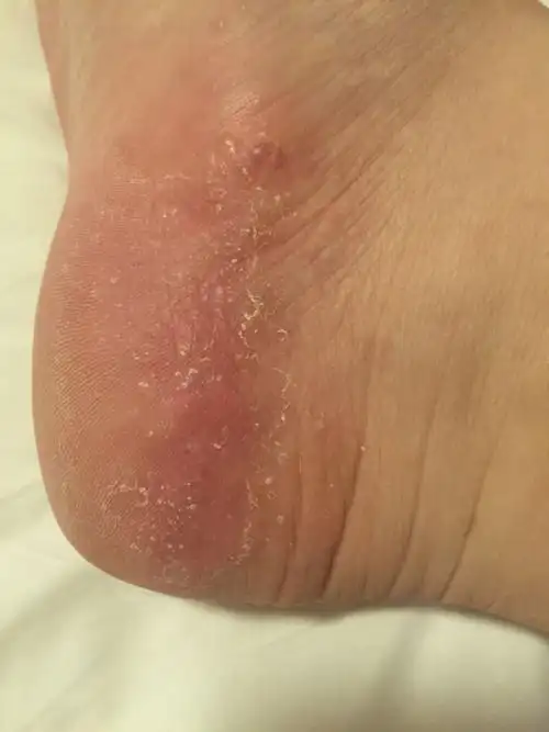 脚上为什么长湿疹 脚上为什么长湿疹怎么办