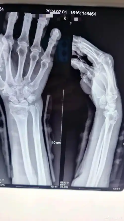 各位老师看看这个colles骨折复位可以不