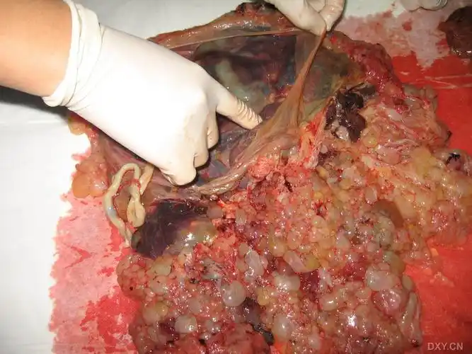 胎盘重2500g,大部分是葡萄胎,大家能看到正常的胎盘组织吗?