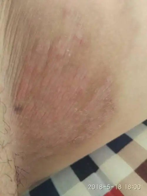 大腿内侧,很痒,3个多月了