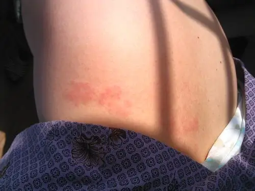 一例典型带状疱疹