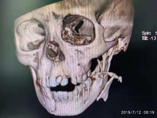 因这个动作,广西一8岁小男孩面部严重撕裂,暑假期间安全不容忽视