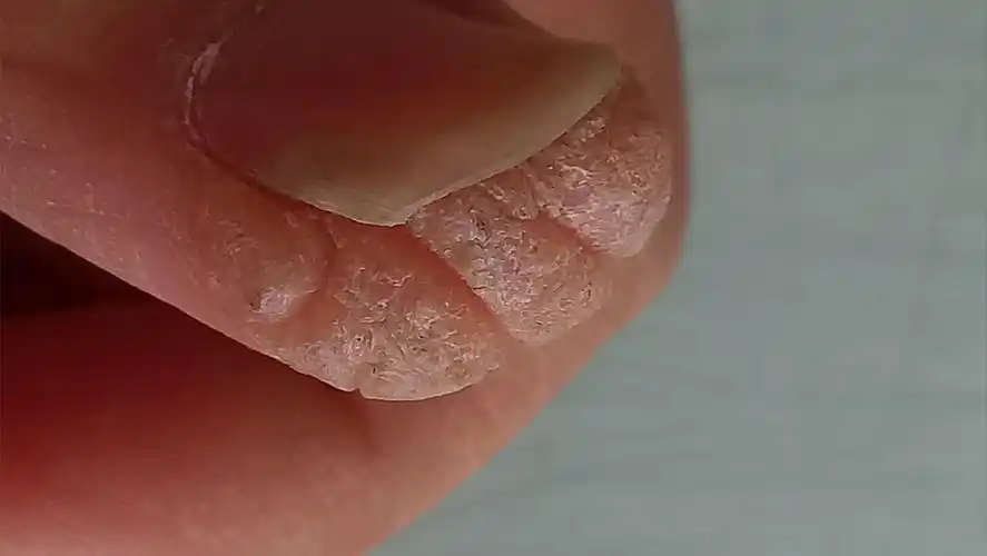 皮肤病大拇指皮肤隆起求诊断及治疗