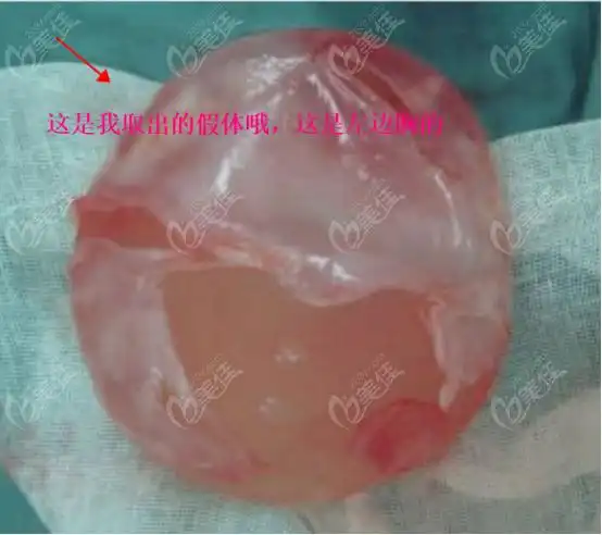 请问菏泽哪家医院隆胸好我隆胸假体取出1个月了想要重新做