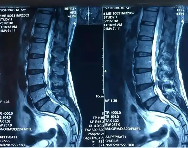 爱你就像爱生命腰椎退行性病变,l4-l5椎间盘向左后突出,马尾神经受压