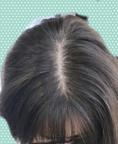 头顶稀疏,发缝看着好宽,这是每一个看到过我头顶的人_圈子-新氧美容